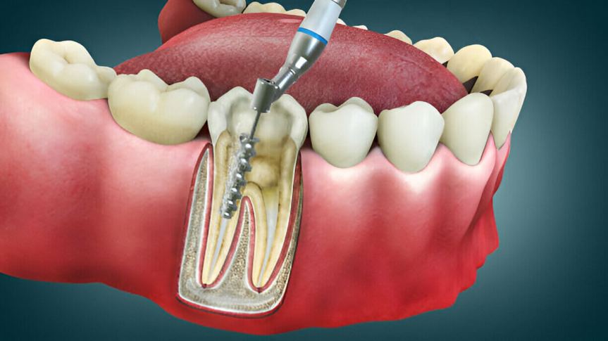 Preserving Your Natural Tooth With Root Canal&nbsp;Treatment